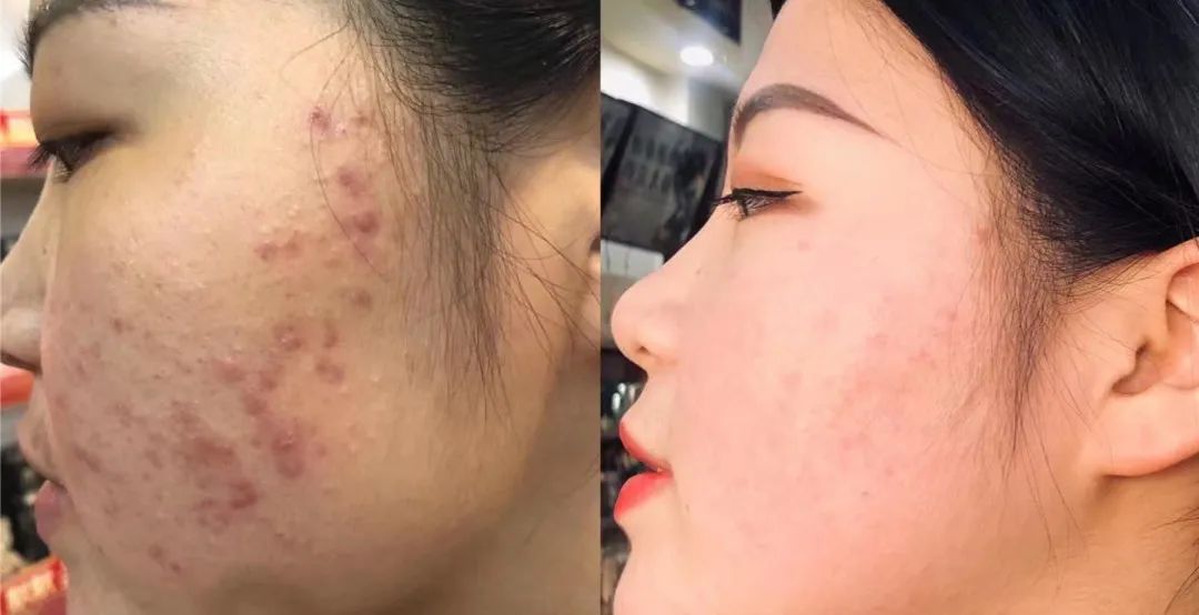 默默717「最美代言人」圆满结束！速戳见证肌肤惊喜蜕变—— – 默默新闻 – 广东默默化妆品有限公司